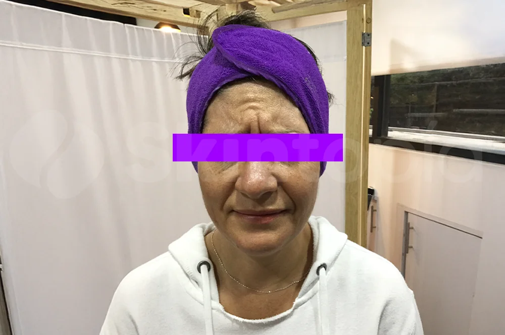 Tratamiento botox - Skintopía