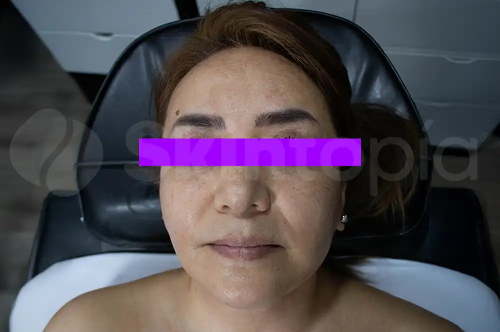 Rejuvenecimiento Facial - Skintopía