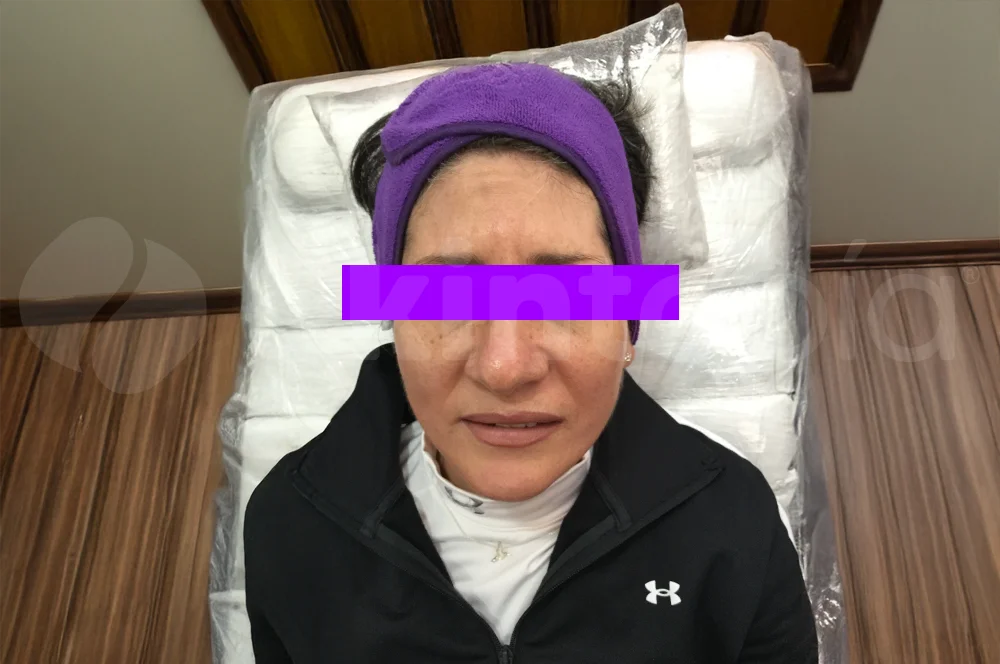 Resultados Tratamiento Botox - Skintopía