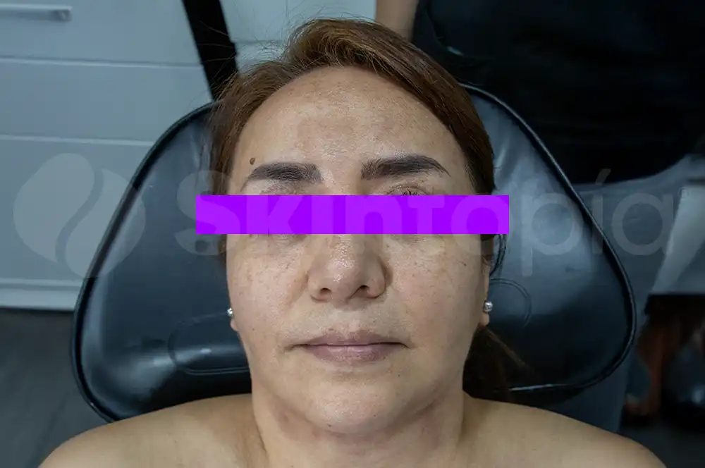 Resultados Rejuvenecimiento Facial - Skintopía