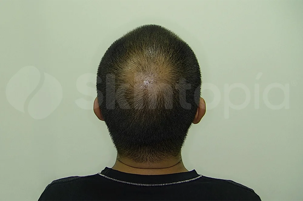 Tratamiento Alopecia- Skintopía - Antes