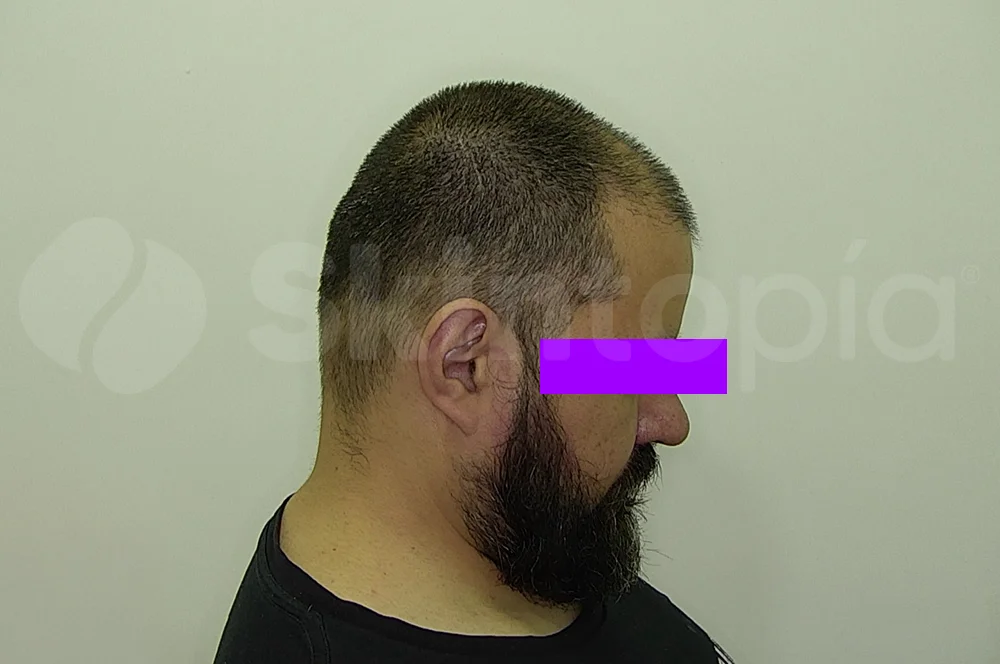Tratamiento alopecia CDMX - Skintopía