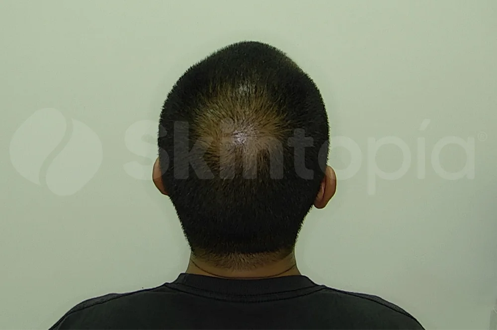 Tratamiento Alopecia- Skintopía - Después