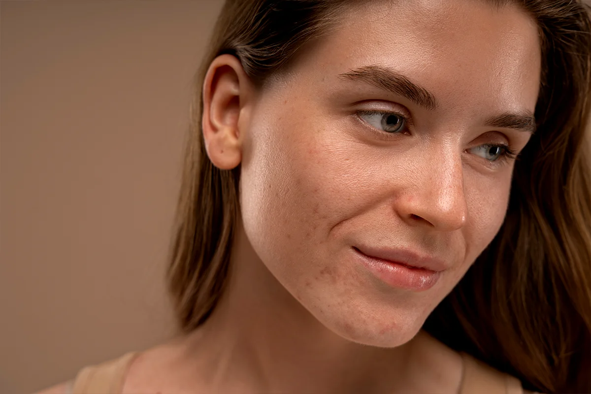 Tratamientos Láser Avanzados para Cicatrices CDMX - Clínica Skintopía