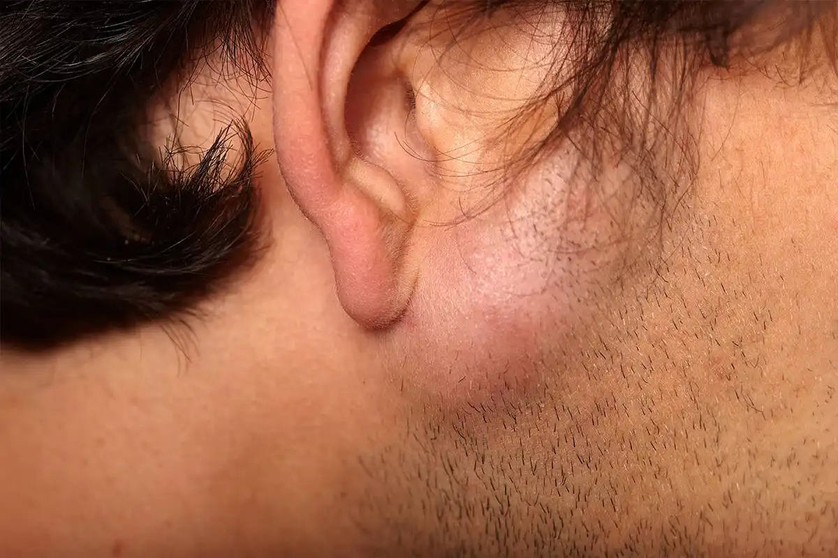 Cirugía de Lipomas CDMX