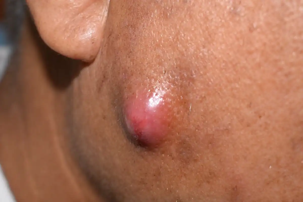 Cirugía de Quistes Cutáneos CDMX - Skintopía