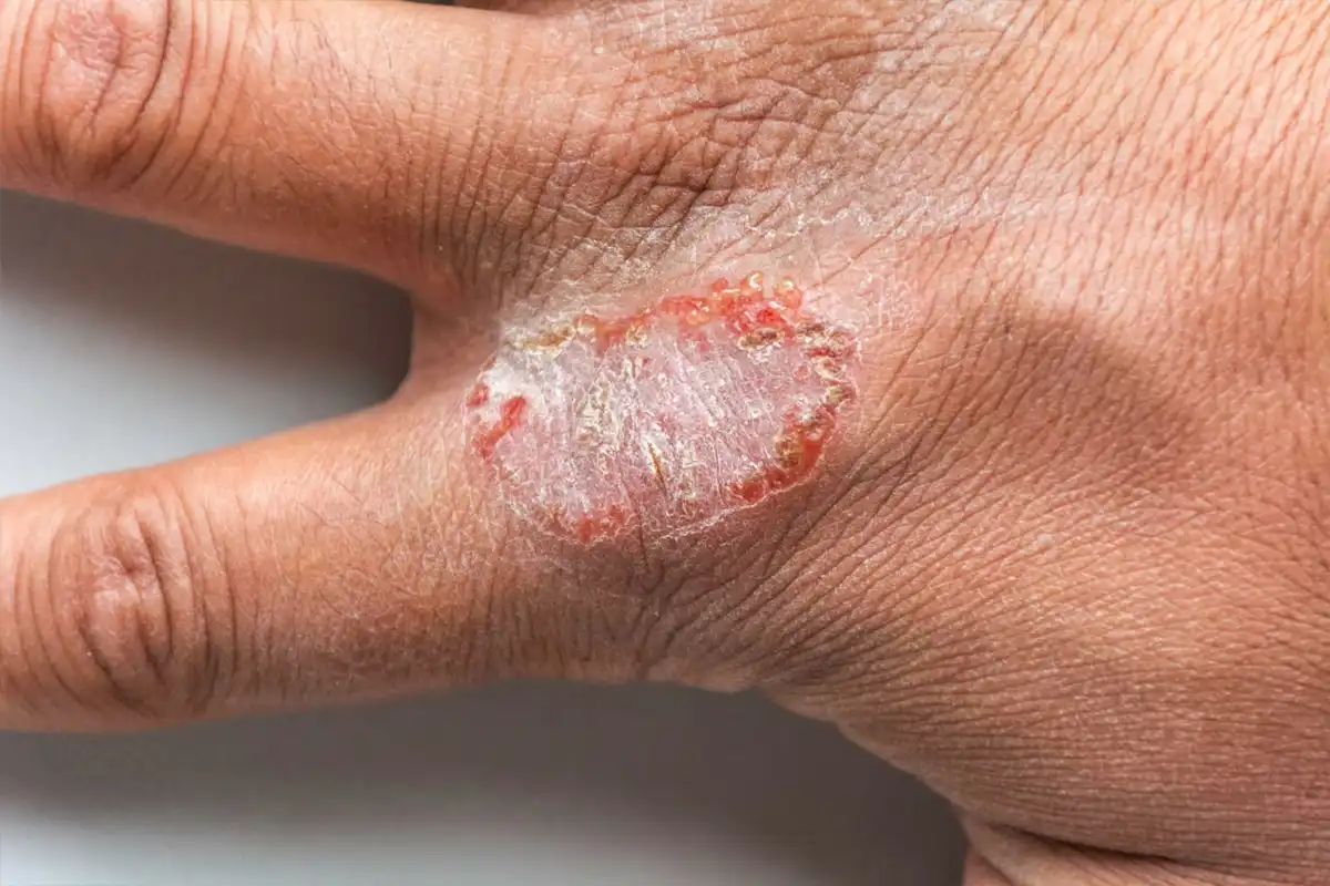 Cirugía de tumores benignos cutaneos