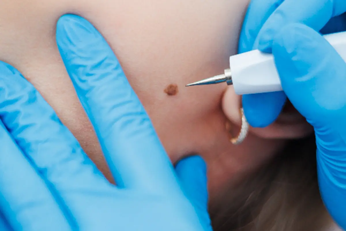 Diagnóstico y Retiro de Lunares - CDMX Skintopía