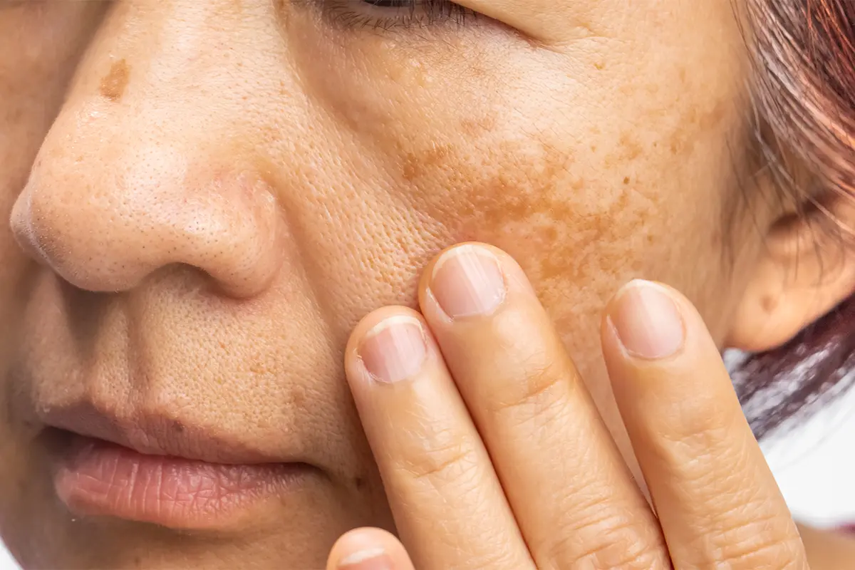 Tratamientos manchas o melasma CDMX