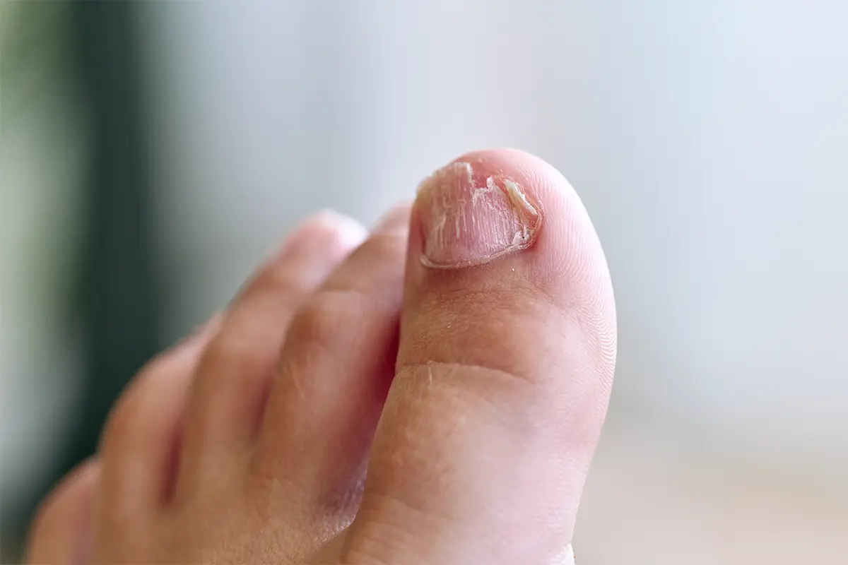 Tratamientos Onicomicosis, Hongos en las Uñas y otros de los pies - Dermatólogos CDMX
