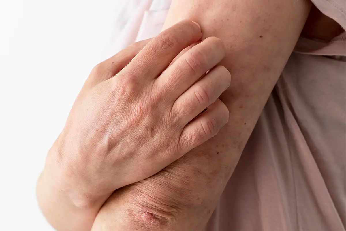 Infecciones Cutaneas - Dermatólogos CDMX Skintopía