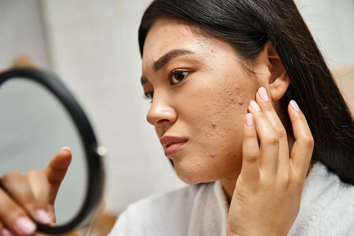 Tratamientos acné todas las edades Skintopía Clínica CDMX