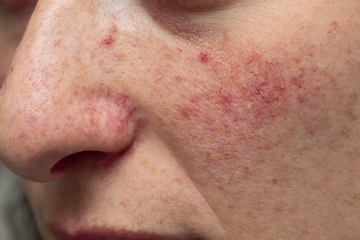 Rosacea en Mujeres u Hombres tratamientos CDMX - Skintopía